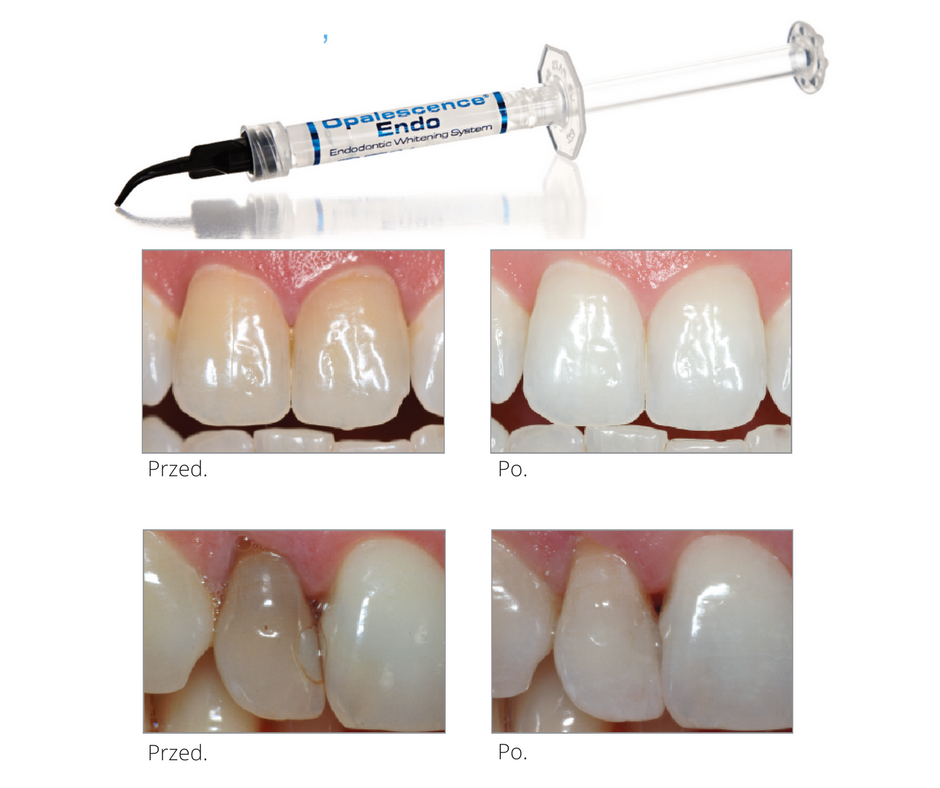 внутрикоронковое отбеливание зубов препараты